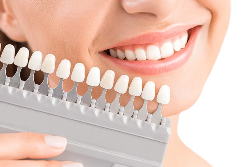 Những điều bạn cần biết về phương pháp bọc răng sứ thẩm mỹ